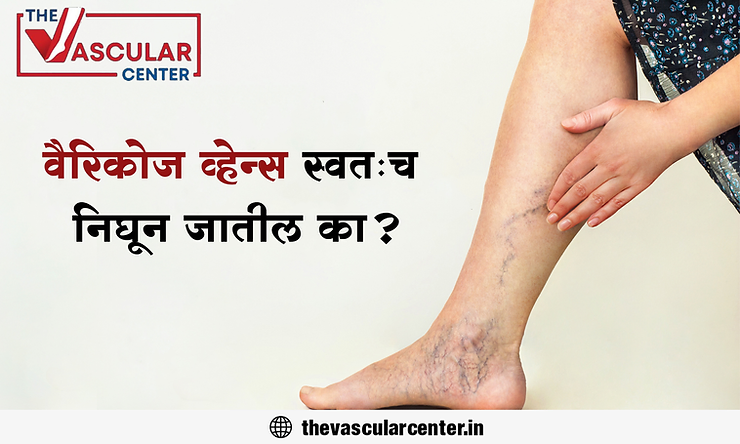 वैरिकोज व्हेन्स स्वतःच निघून जातील का ?