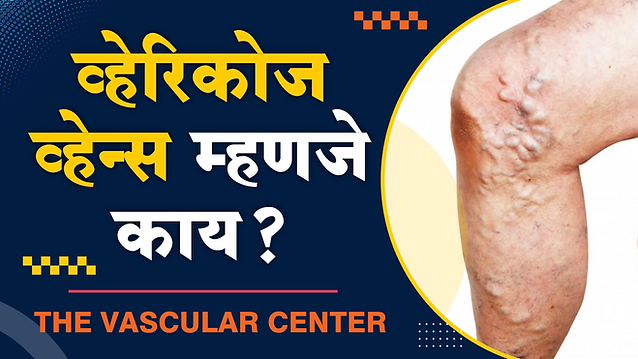 व्हेरिकोज व्हेन म्हणजे काय` याची माहिती खालील प्रमाणे डॉक्टर अमोल लाहोटी यांनी दिली आहे