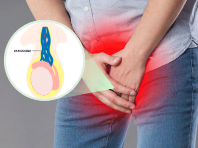 Varicocele